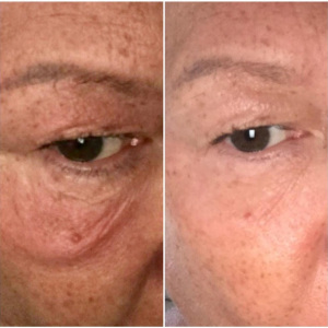 BEFORE-AND-AFTER-FACE-SPLITMASSAGE-TREATMENTS