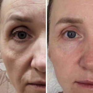 FACIAL-SPLITMASSAGE-BEFORE-AND-AFTER
